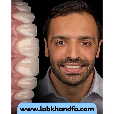 بعد نمونه کار لمینت دندان دکتر فاطمه زنگنه