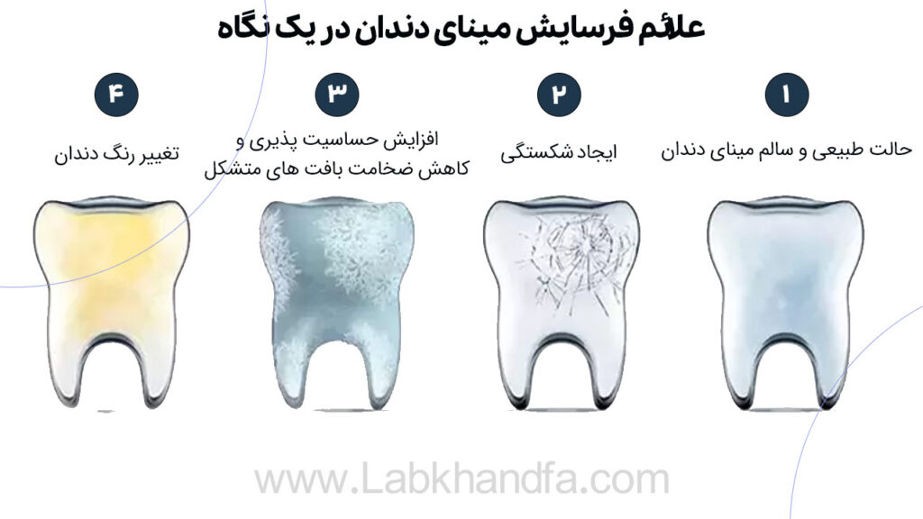 علائم فرسایش مینای دندان در یک نگاه