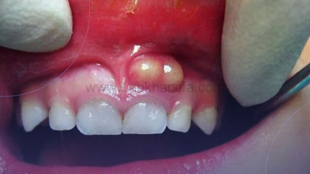عکسی از عفونت لثه کودکان