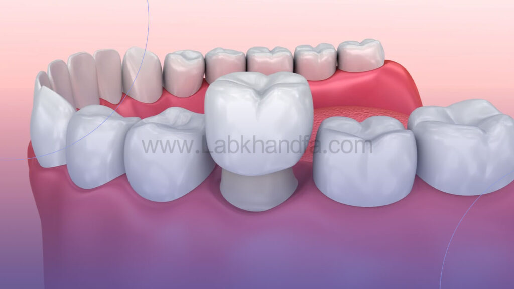 عکس شماتیک روکش دندان