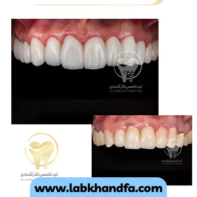 قبل و بعد نمونه کار دیگری از لمینت دندان دکتر عزیز گشاده رو