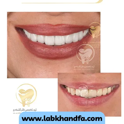 قبل و بعد نمونه کار لمینت دندان دکتر عزیز گشاده رو