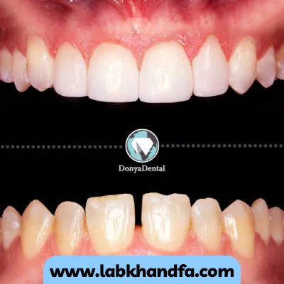 قبل و بعد نمونه کار لمینت کلینیک دندانپزشکی دنیا دنتال