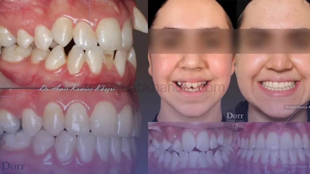 نمونه درمان ارتودنسی کلینیک دندانپزشکی دُر