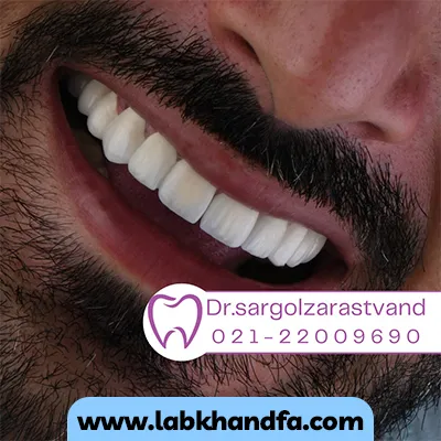 نمونه کار دیگری از بعد لمینت دندان دکتر سارگل زراست وند