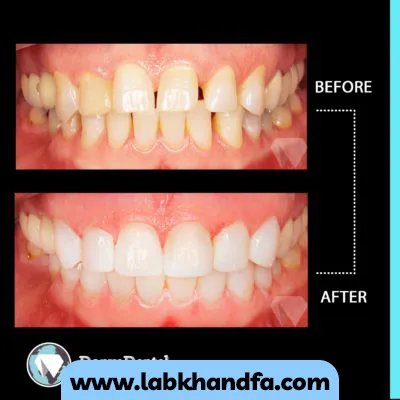 یک نمونه کار دیگر از قبل و بعد کلینیک دندانپزشکی دنیا دنتال