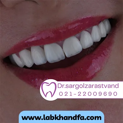 یک نمونه کار دیگر بعد لمینت دندان دکتر سارگل زراست وند