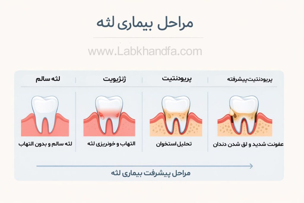 مراحل بیماری لثه