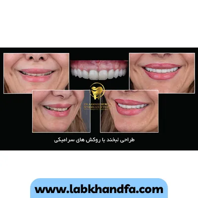 طراحی لبخند با روکش های لمینت سرامیکی توسط دکتر عزیز گشاده رو