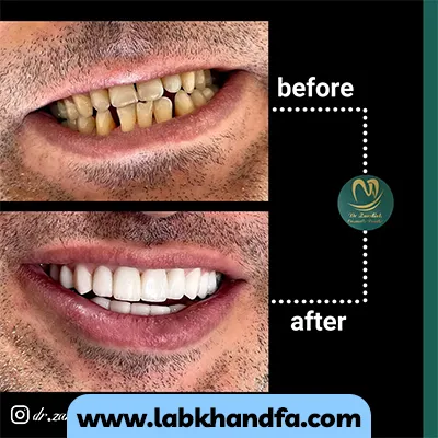 قبل و بعد نمونه کار لمینت دندان دکتر زهرا زندیه