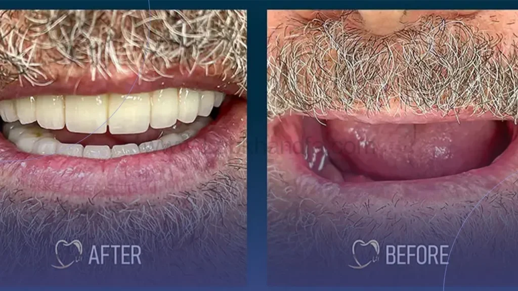 نمونه کار ایمپلنت کلینیک دندانپزشکی الماس تهران