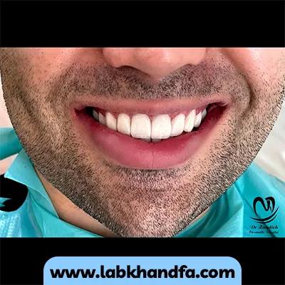 نمونه کار لمینت دندان دکتر زهرا زندیه