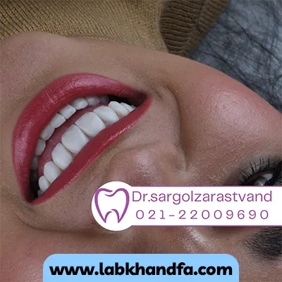 نمونه کار بعد لمینت دندان دکتر سارگل زراست وند