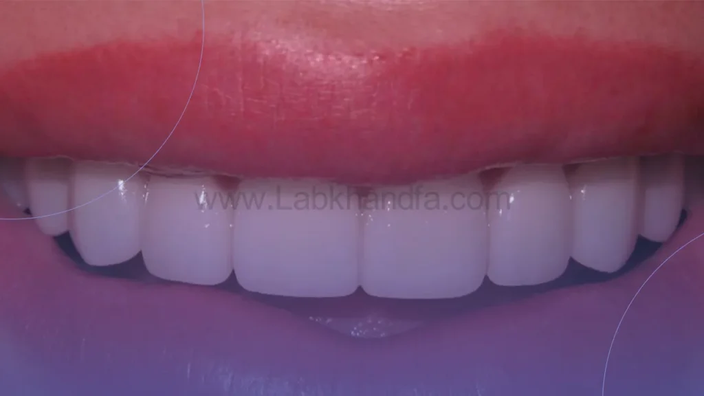 نمونه کار لمینت دندان کلینیک دندانپزشکی یوسف آباد