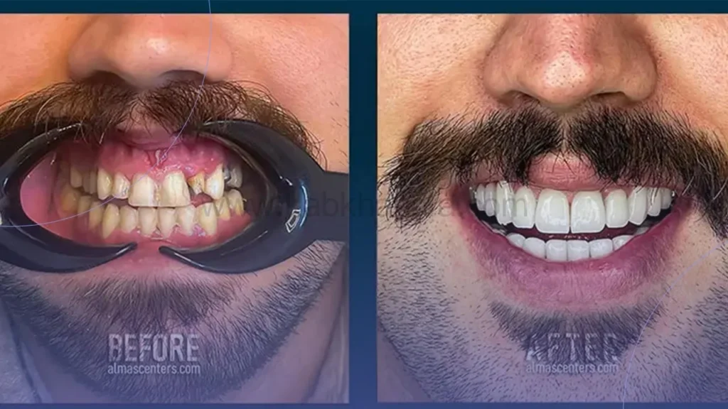 نمونه کار لمینت کلینیک دندانپزشکی الماس تهران