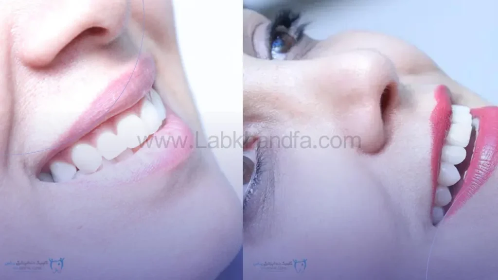 نمونه کار نصب لمینت دندان کلینیک دندانپزشکی یاس