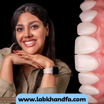 یک نمونه دیگر از بعد لمینت دندان دکتر فاطمه زنگنه