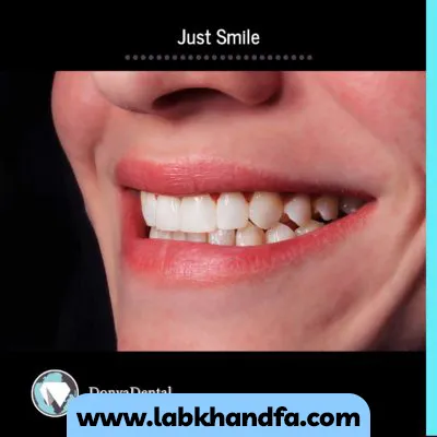 یک نمونه کار بعد نصب لمینت دندان کلینیک دندانپزشکی دنیا دنتال