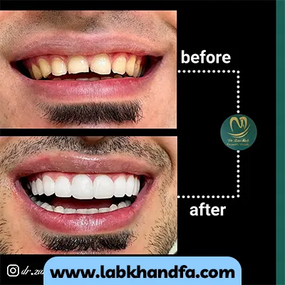 یک نمونه کار دیگر از قبل و بعد لمینت دندان دکتر زهرا زندیه