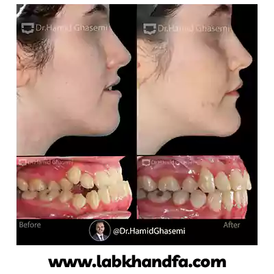 قبل و بعد درمان ارتودنسی و ارتوسرجری دکتر حمید قاسمی