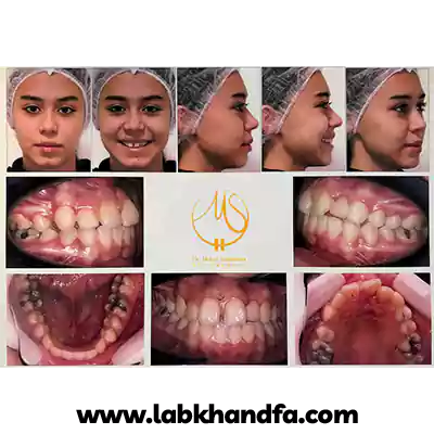 قبل و بعد نمونه کار ارتودنسی دندان دکتر میلاد سلیمانی