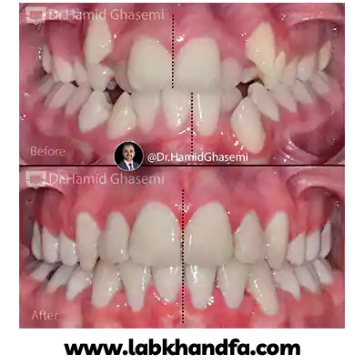 قبل و بعد نمونه کار ارتودنسی دکتر حمید قاسمی