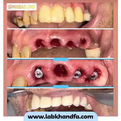قبل و بعد نمونه کار ایمپلنت دندان دکتر محسن عباسی