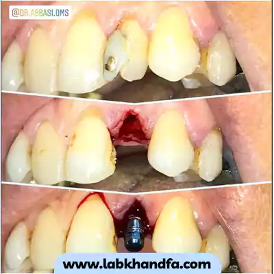 قبل و بعد نمونه کار کاشت ایمپلنت توسط دکتر محسن عباسی