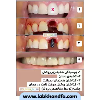 قبل و بعد نمونه کار کاشت ایمپلنت دندانی دکتر محسن عباسی