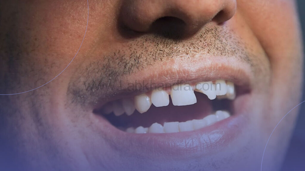 لب پر شدن دندان جلو