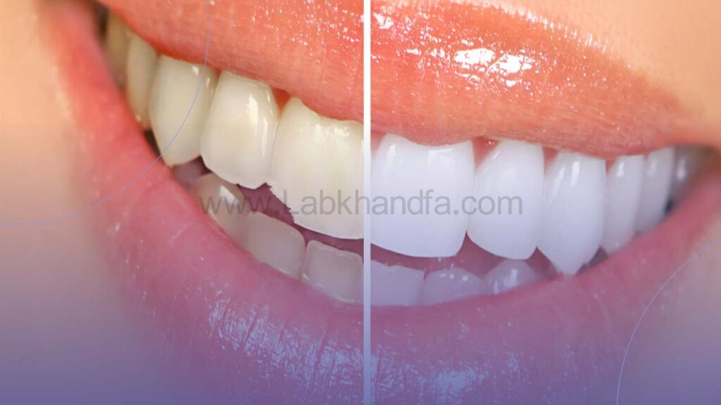لمینت دندان لب پر شده