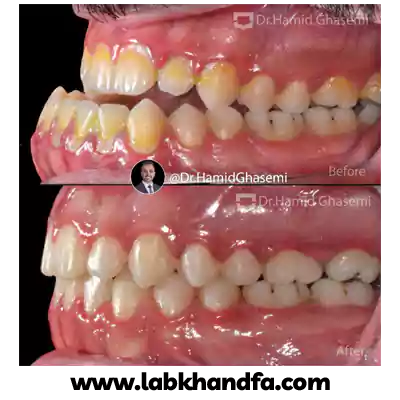 نمونه درمان ارتودنسی دکتر حمید قاسمی