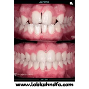 نمونه کار ارتودنسی دکتر حجت درویش پور کاخکی شماره 1