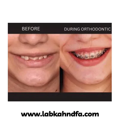 نمونه کار ارتودنسی دکتر حسین ارباب زاده بروجنی شماره 1