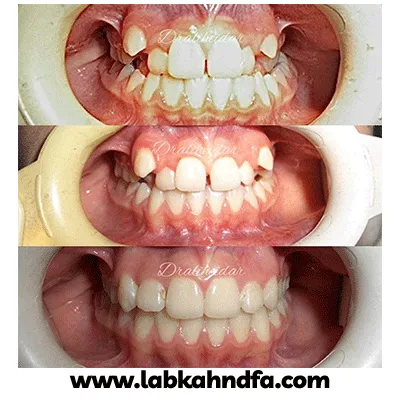 نمونه کار ارتودنسی دکتر علی حیدری