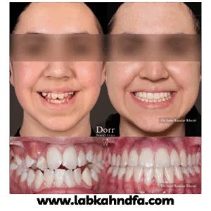 نمونه کار ارتودنسی دکتر کامیار خضری شماره 1
