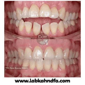 نمونه کار ارتودنسی دکتر کامیار خضری شماره 2