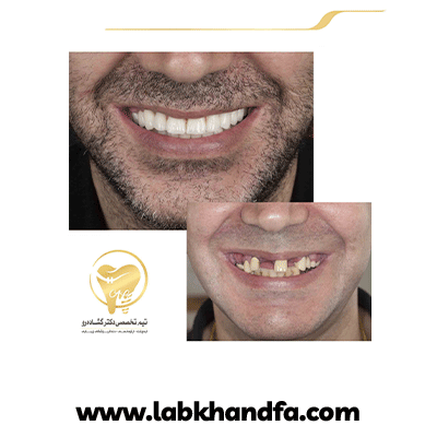 نمونه کار ایمپلنت دکتر عزیز گشاده رو