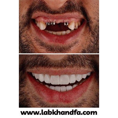 نمونه کار ایمپلنت دکتر محمدرضا باقری