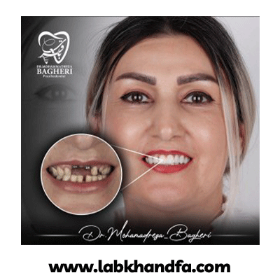 نمونه کار ایمپلنت دکتر محمدرضا باقری