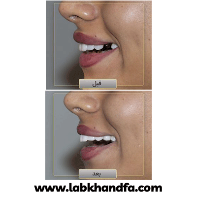 نمونه کار ایمپلنت دکتر وحید دهقان شماره 2