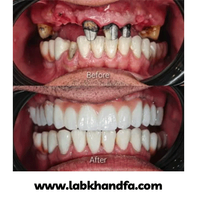 نمونه کار ایمپلنت دکتر وحید سعیدیان