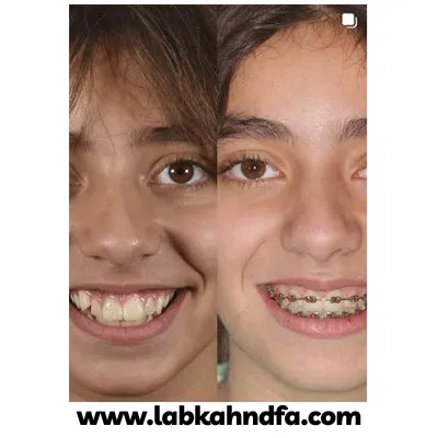 نمونه کار ارتودنسی کودکان دکتر محمد فراهانی