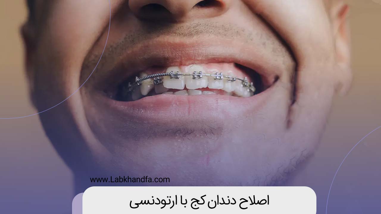 اصلاح دندان کج با ارتودنسی