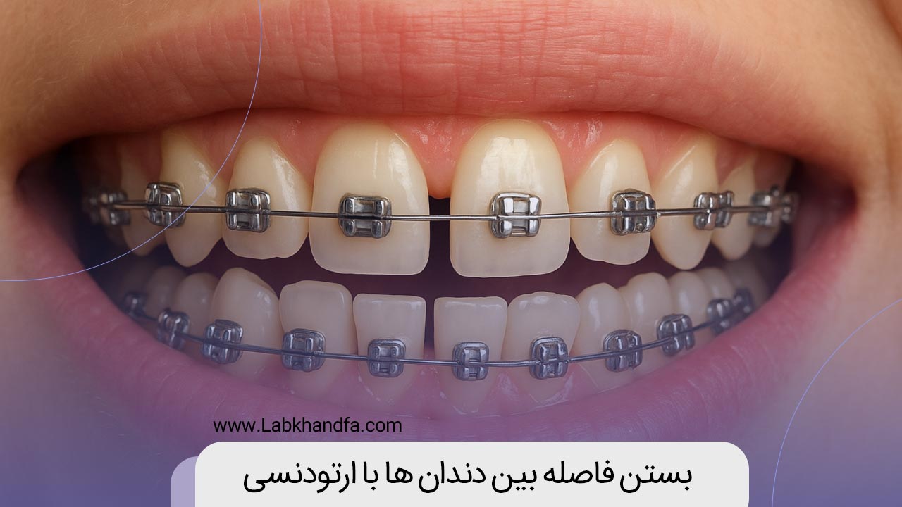 بستن فاصله بین دندان ها با ارتودنسی