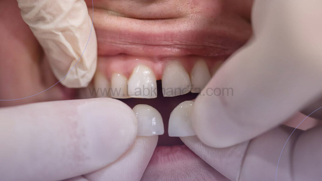 جداسازی باندینگ کامپوزیت 2 دندان جلویی فک بالایی