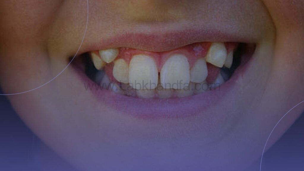 دندان های نامرتب کودکان