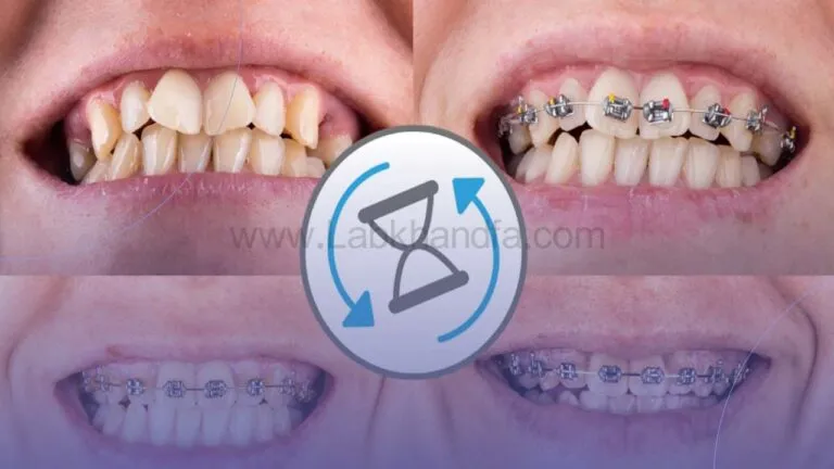 عکسی از مراحل بهبودی ناهنجاری های دهانی با روش ارتودنسی