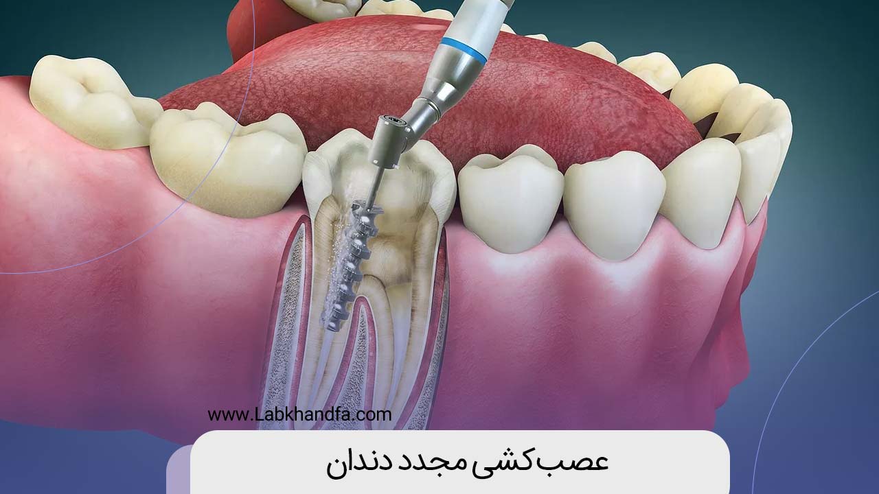 عصب کشی مجدد دندان