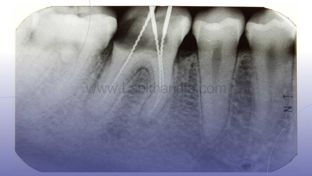 عکس رادیوگرافی دندان عصب کشی شده